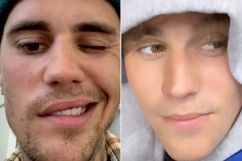 Justin Bieber ndan përditësimin e lëvizjes së fytyrës pas diagnostikimit të sindromës Ramsay Hunt