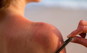 Çfarë i ndodh lëkurës kur digjemi nga dielli – Si të kujdeseni 