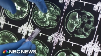 FDA miraton testin e parë të gjakut për të ndihmuar në diagnostikimin e sëmundjes së Alzheimerit 
