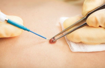 Shenjat që kërkojnë ekzaminim urgjent dermatologjik 
