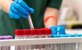 FDA miraton një tjetër test gjaku për diagnostikimin e sëmundjes Alzheimer